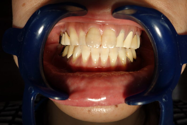 前歯6本の治療